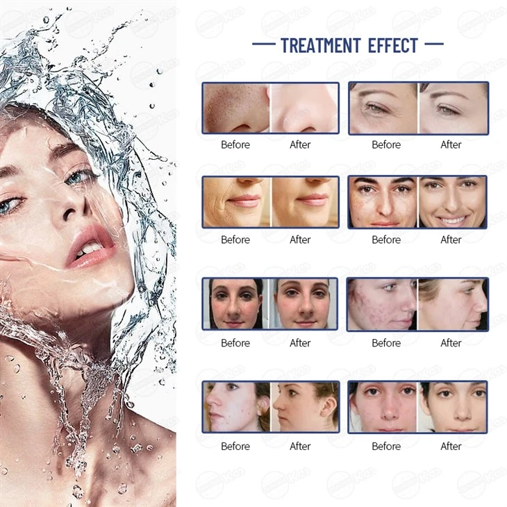 H2O2 Skin Care Dermabrasion Facial Machine high quality
